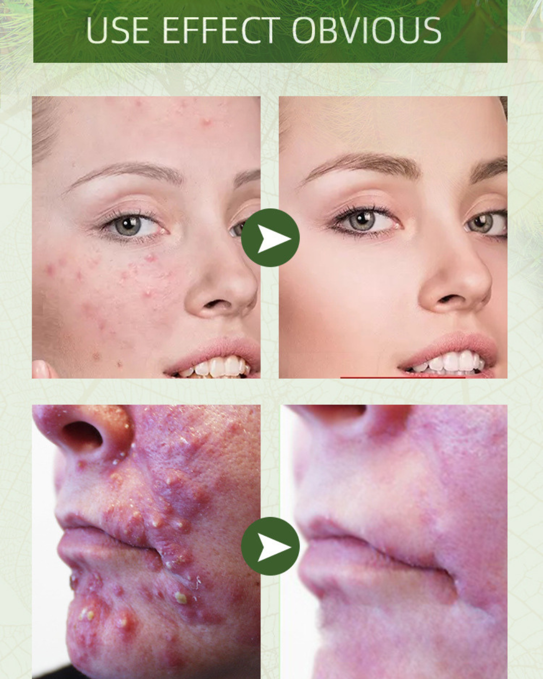 Herbal Anti-Acne Brightening Care Cream