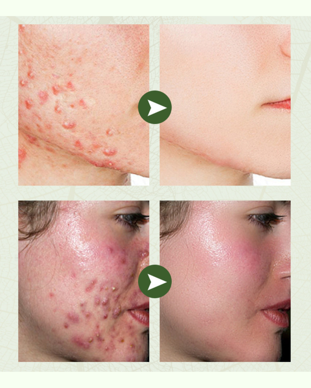 Herbal Anti-Acne Brightening Care Cream